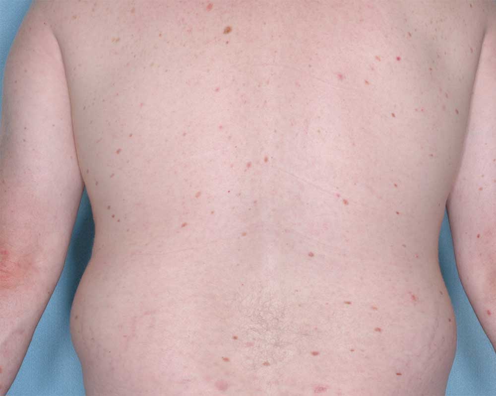 Picture of Otezla results on back affected with psoriasis after treatment