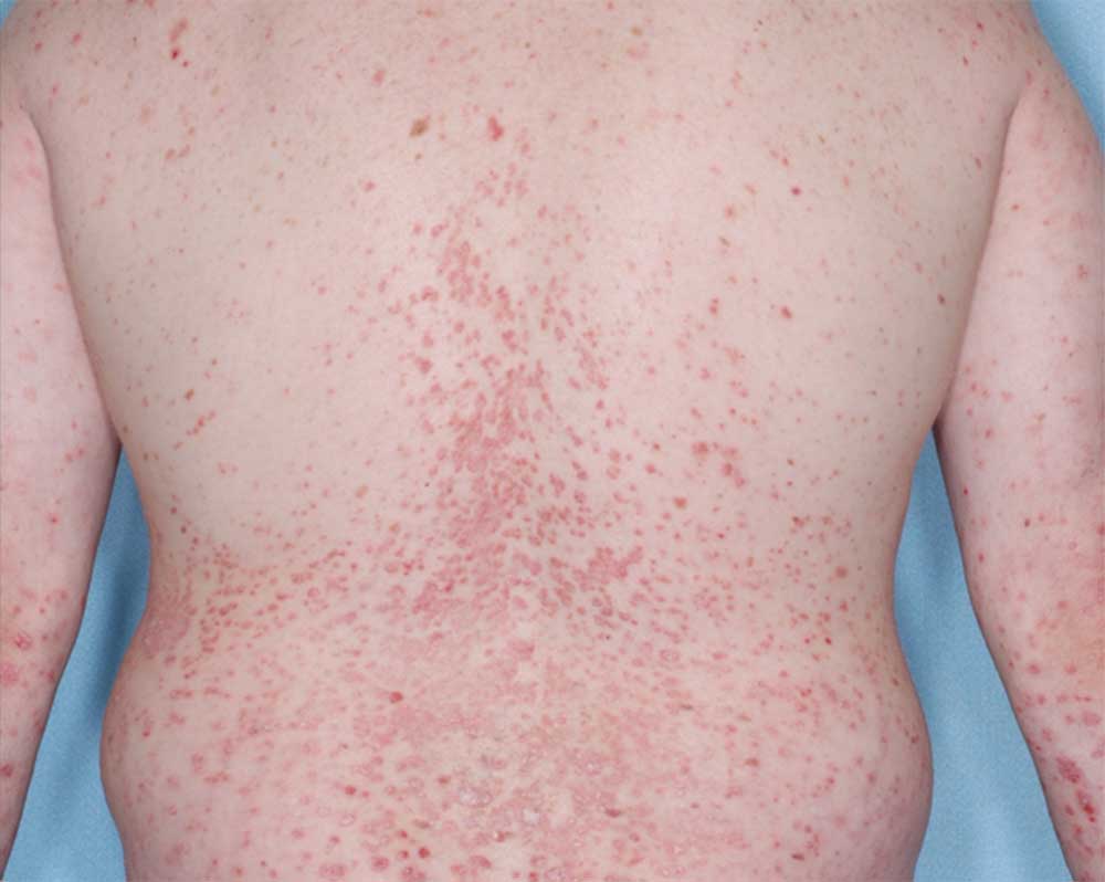 Picture of back affected with psoriasis before treatment