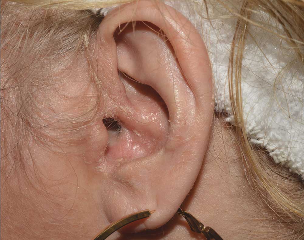 Picture of Otezla results on ear affected with psoriasis after treatment
