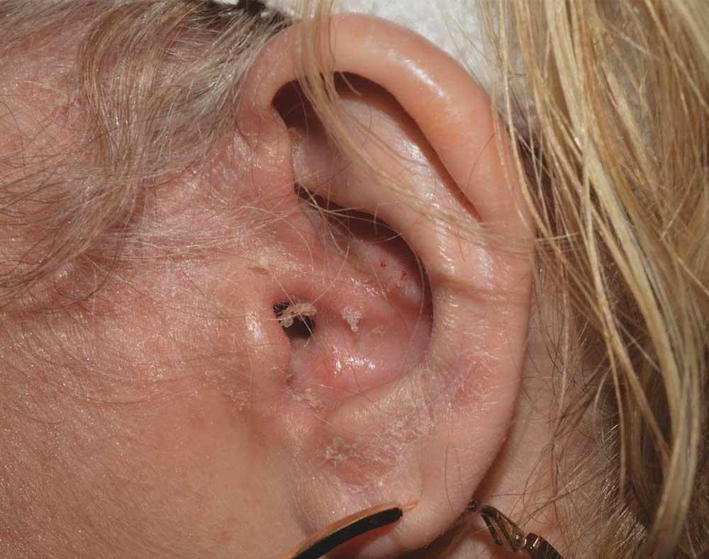 Picture of ear affected with psoriasis before treatment