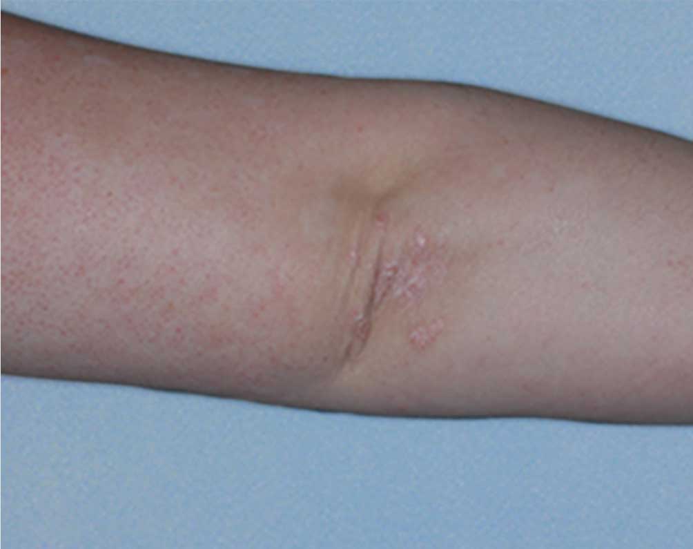 Picture of Otezla results on elbows affected with psoriasis after treatment