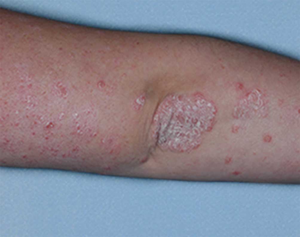 Picture of elbows affected with psoriasis before and after treatment