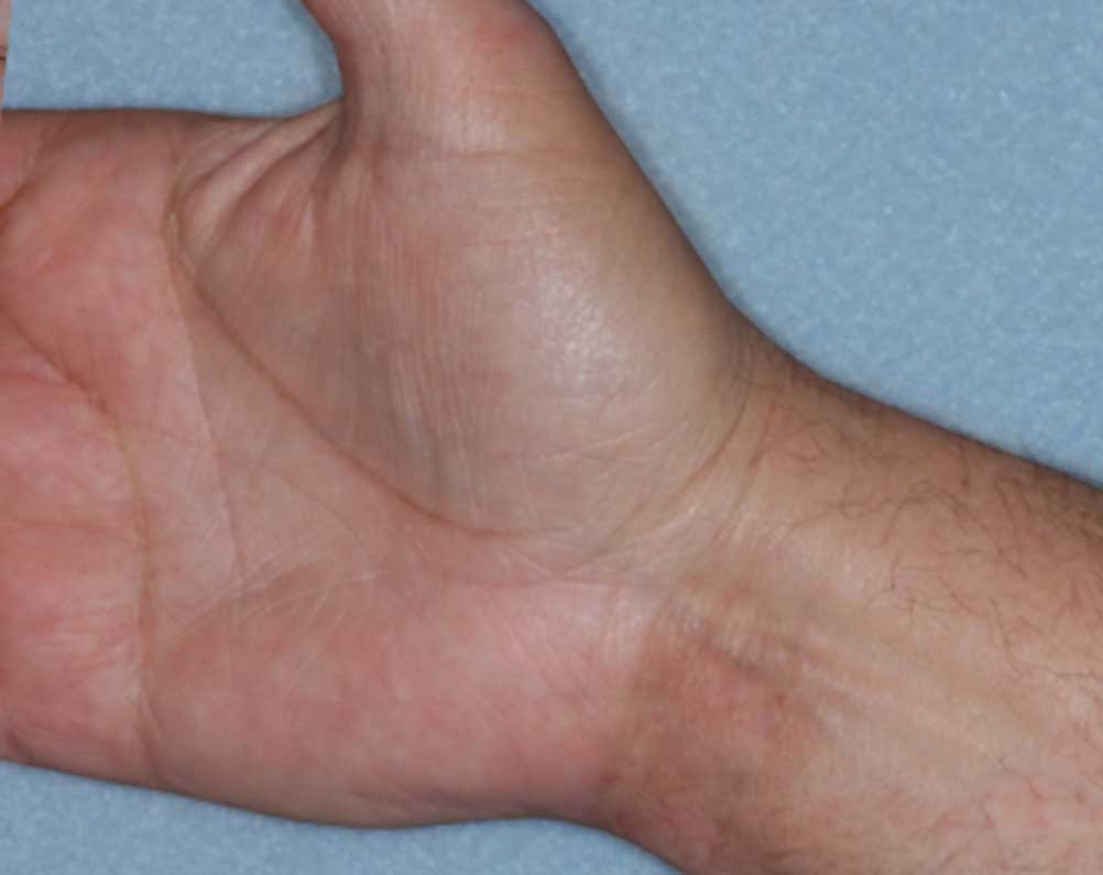 Picture of Otezla results on hands affected with psoriasis after treatment
