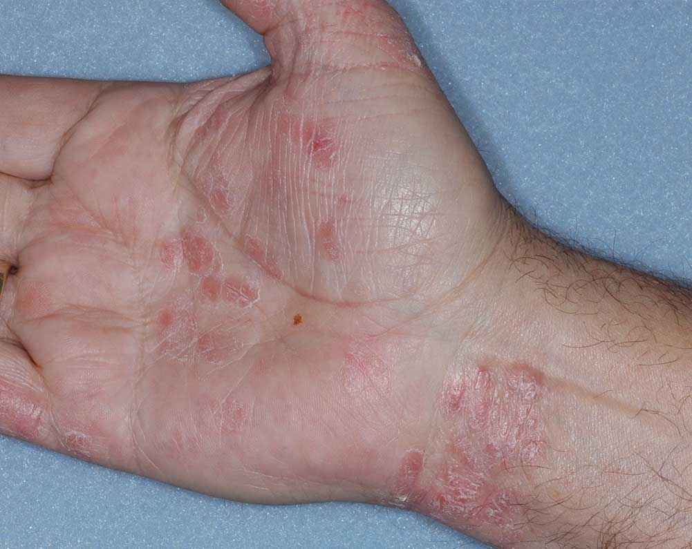 Picture of hands affected with psoriasis before treatment