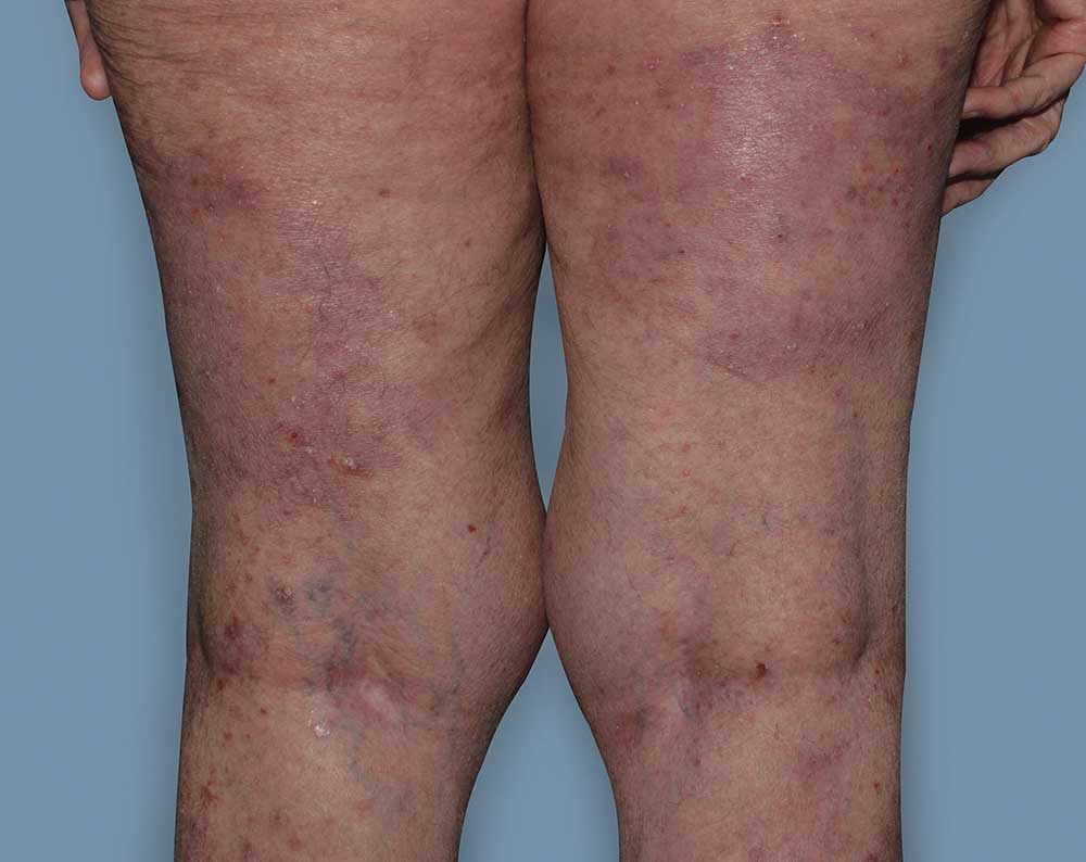 Picture of Otezla results on legs affected with psoriasis after treatment