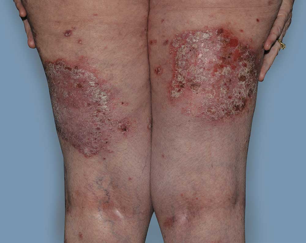 Picture of legs affected with psoriasis before treatment