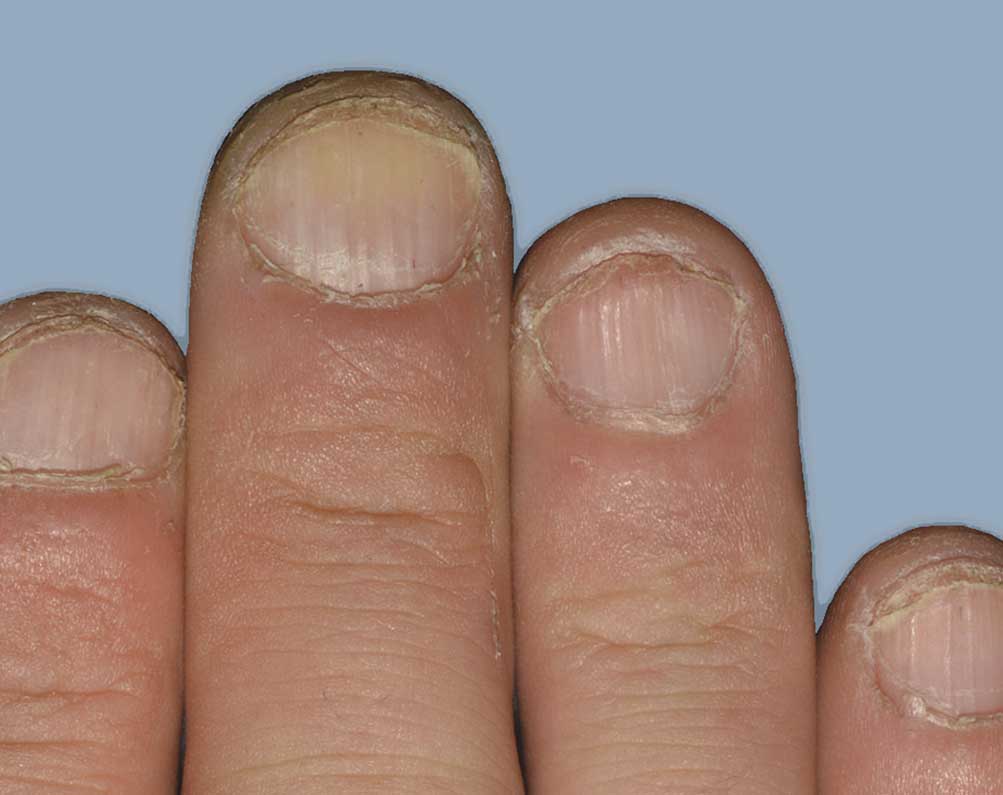Picture of Otezla results on nails affected with psoriasis after treatment