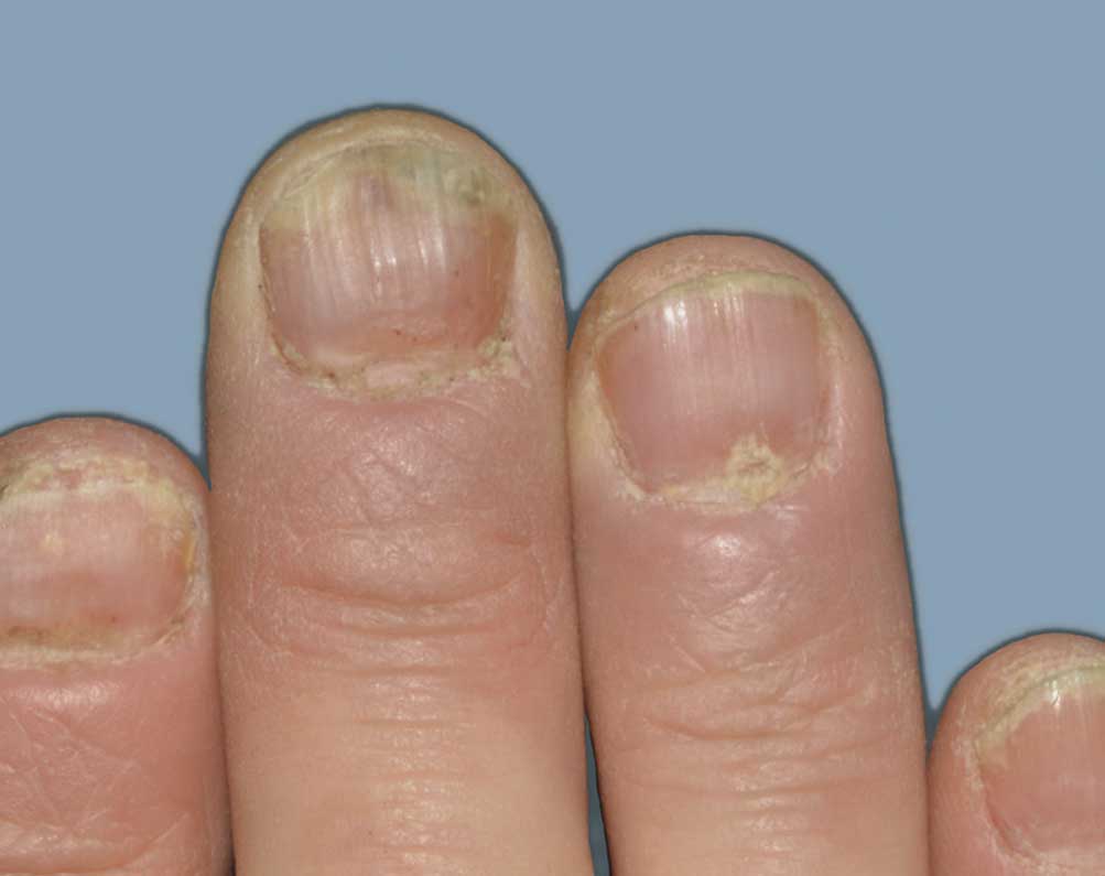 Picture of nails affected with psoriasis before treatment