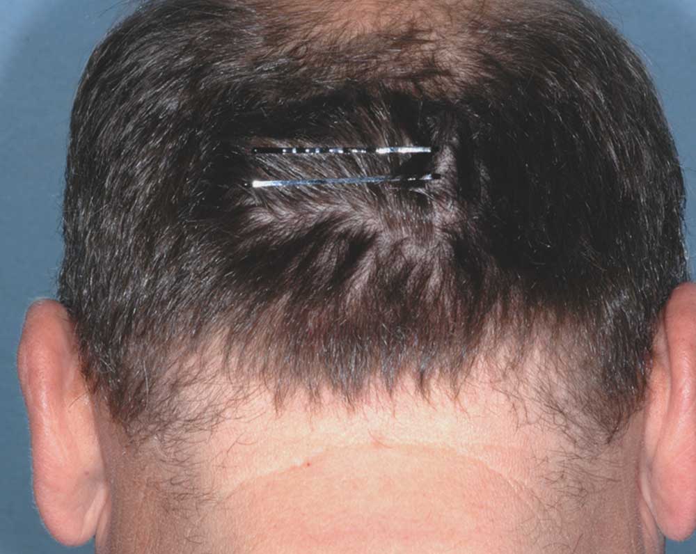 Picture of Otezla results on scalp affected with psoriasis after treatment
