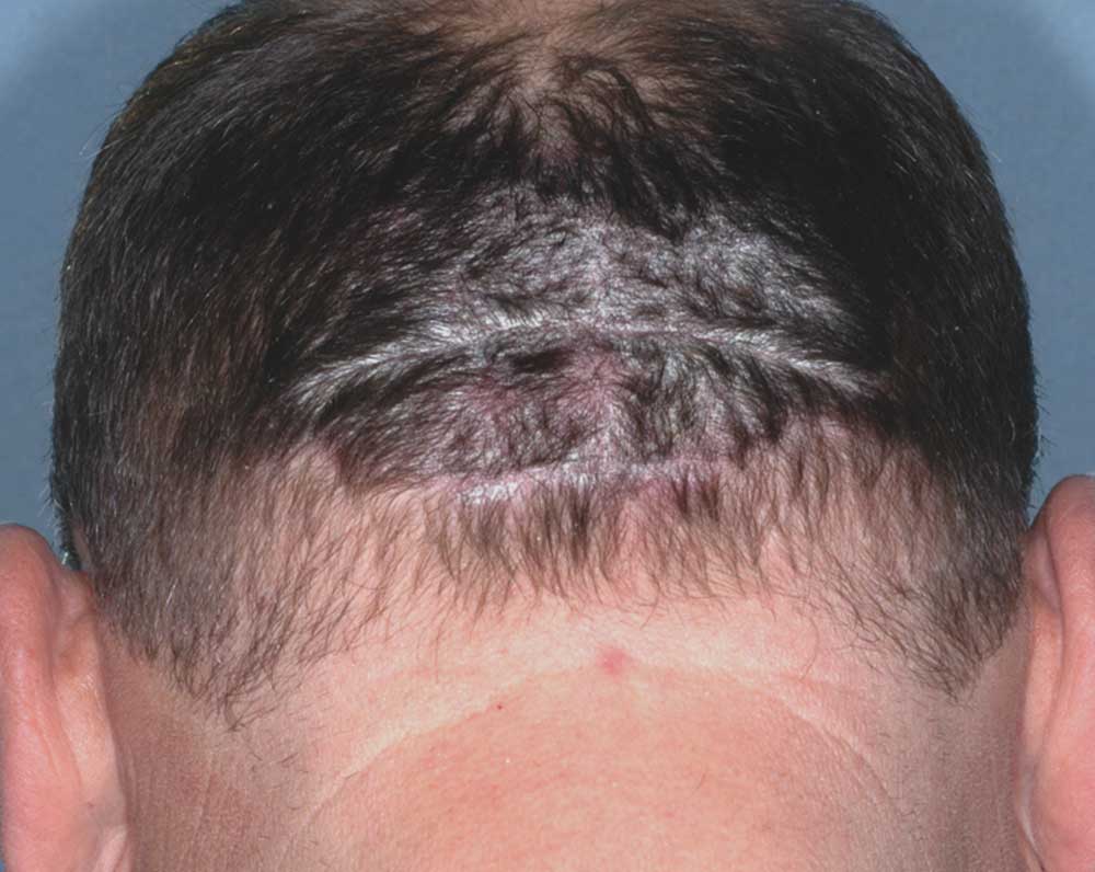 Picture of scalp affected with psoriasis before treatment