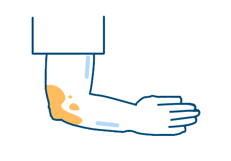 Elbow with healing inflammation from plaque psoriasis