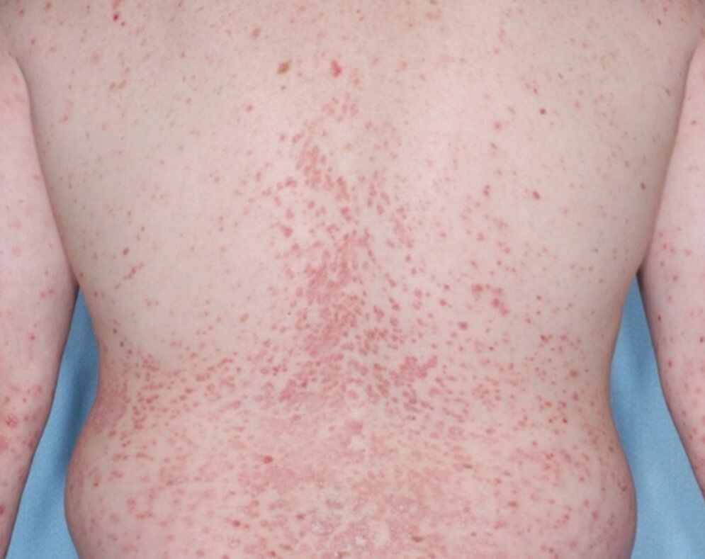 Before and after photos of various Otezla® (apremilast) patients