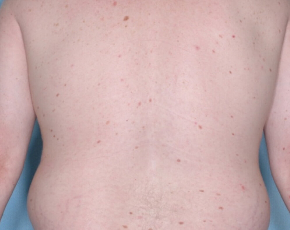 Before and after photos of various Otezla® (apremilast) patients
