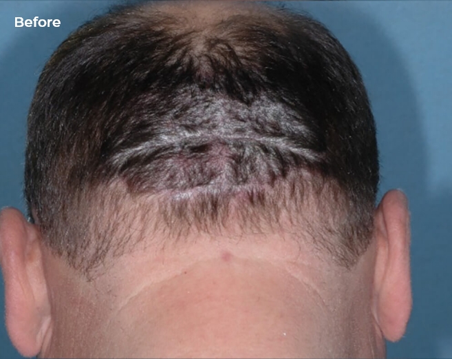 Before and after photos of an Otezla® (apremilast) patient's scalp