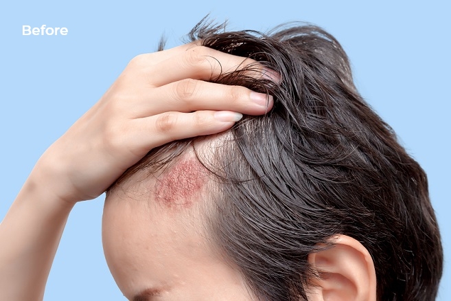 Before and after photos of an Otezla® (apremilast) patient's scalp-tab1
