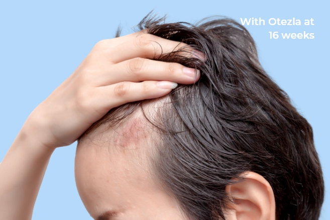 Before and after photos of an Otezla® (apremilast) patient's scalp-tab1